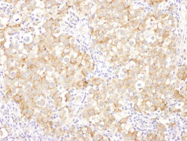 DBN1 / Drebrin Antibody - Detection of human Drebrin by immunohistochemistry. Sample: FFPE section of human ovarian carcinoma. Antibody: Affinity purified rabbit anti- Drebrin used at a dilution of 1:1,000 (1µg/ml). Detection: DAB