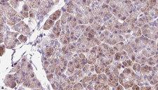 DBN1 / Drebrin Antibody - 1:100 staining human pancreas carcinoma tissue by IHC-P. The sample was formaldehyde fixed and a heat mediated antigen retrieval step in citrate buffer was performed. The sample was then blocked and incubated with the antibody for 1.5 hours at 22°C. An HRP conjugated goat anti-rabbit antibody was used as the secondary.
