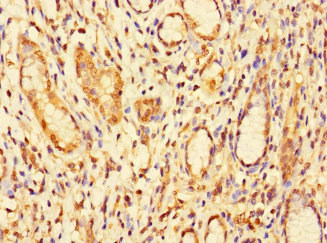 DBR1 Antibody - Immunohistochemistry of paraffin-embedded human gastric cancer at dilution 1:100