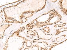 DCAF10 Antibody - Immunohistochemistry of paraffin-embedded Human thyroid cancer tissue  using DCAF10 Polyclonal Antibody at dilution of 1:55(×200)