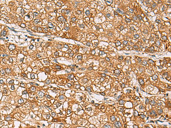 DCAF12 / WDR40A Antibody - Immunohistochemistry of paraffin-embedded Human liver cancer tissue  using DCAF12 Polyclonal Antibody at dilution of 1:65(×200)