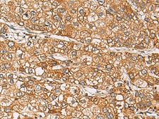 DCAF12 / WDR40A Antibody - Immunohistochemistry of paraffin-embedded Human liver cancer tissue  using DCAF12 Polyclonal Antibody at dilution of 1:65(×200)