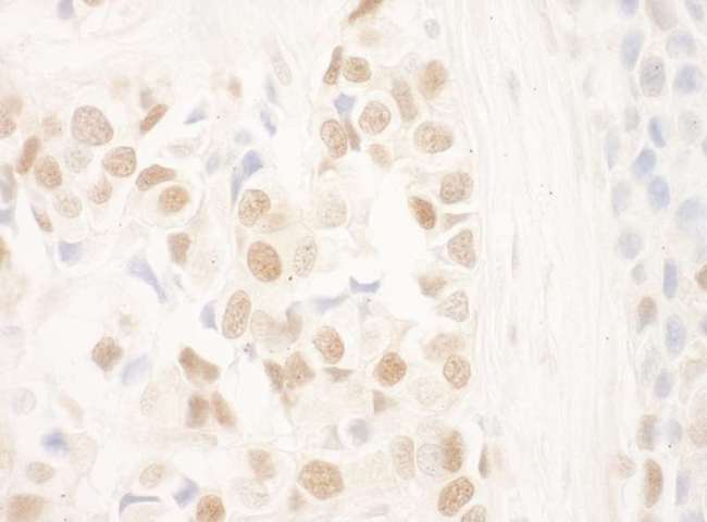 DCAF6 / NRIP Antibody - Detection of Human NRIP by Immunohistochemistry. Sample: FFPE section of human breast carcinoma. Antibody: Affinity purified rabbit anti-NRIP used at a dilution of 1:250.