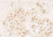 DCAF6 / NRIP Antibody - Detection of Human NRIP by Immunohistochemistry. Sample: FFPE section of human breast carcinoma. Antibody: Affinity purified rabbit anti-NRIP used at a dilution of 1:200 (1 ug/ml). Detection: DAB.