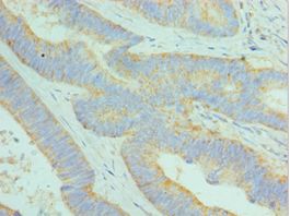 DCAF7 / WDR68 Antibody - Immunohistochemistry of paraffin-embedded human colon cancer using antibody at 1:100 dilution.