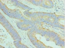 DCAF7 / WDR68 Antibody - Immunohistochemistry of paraffin-embedded human colon cancer using DCAF7 Antibody at dilution of 1:100