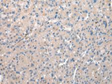 DCAF7 / WDR68 Antibody - Immunohistochemistry of paraffin-embedded Human liver cancer tissue  using DCAF7 Polyclonal Antibody at dilution of 1:30(×200)