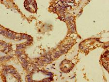 DCAF8 / WDR42A Antibody - Immunohistochemistry of paraffin-embedded human endometrial cancer at dilution 1:100