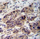DCAF8L2 Antibody - WDR42C Antibody immunohistochemistry of formalin-fixed and paraffin-embedded human breast carcinoma followed by peroxidase-conjugated secondary antibody and DAB staining.