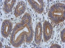 DCBLD2 Antibody - IHC of paraffin-embedded Colon ca, using DCBLD2 antibody at 1:500 dilution.