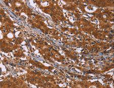 DCBLD2 Antibody - Immunohistochemistry of paraffin-embedded Human colon cancer using DCBLD2 Polyclonal Antibody at dilution of 1:50.