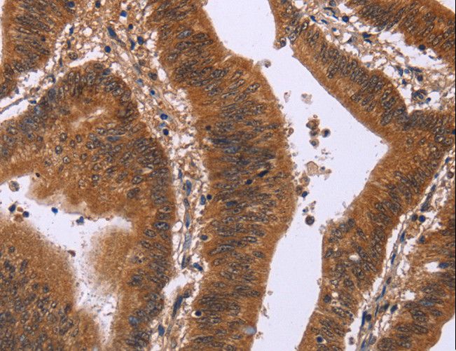 DCBLD2 Antibody - Immunohistochemistry of paraffin-embedded Human colon cancer using DCBLD2 Polyclonal Antibody at dilution of 1:50.