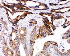 DCC Antibody - DCC antibody. IHC(P): Human Intestinal Cancer Tissue.
