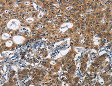 DCC Antibody - Immunohistochemistry of paraffin-embedded Human liver cancer using DCC Polyclonal Antibody at dilution of 1:70.