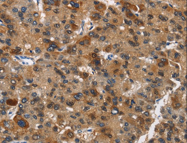 DCC Antibody - Immunohistochemistry of paraffin-embedded Human liver cancer using DCC Polyclonal Antibody at dilution of 1:70.