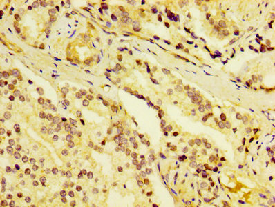 DCD / Dermcidin Antibody - IHC image of DCD Antibody diluted at 1:400 and staining in paraffin-embedded human prostate cancer performed on a Leica BondTM system. After dewaxing and hydration, antigen retrieval was mediated by high pressure in a citrate buffer (pH 6.0). Section was blocked with 10% normal goat serum 30min at RT. Then primary antibody (1% BSA) was incubated at 4°C overnight. The primary is detected by a biotinylated secondary antibody and visualized using an HRP conjugated SP system.