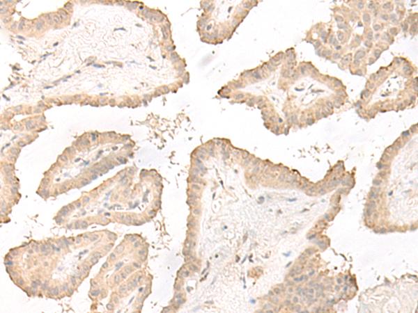DCD / Dermcidin Antibody - Immunohistochemistry of paraffin-embedded Human thyroid cancer tissue  using DCD Polyclonal Antibody at dilution of 1:35(×200)