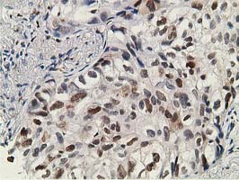 DCK / Deoxycytidine kinase Antibody - IHC of paraffin-embedded Carcinoma of Human lung tissue using anti-DCK mouse monoclonal antibody.