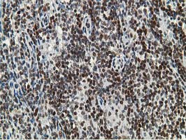 DCK / Deoxycytidine kinase Antibody - IHC of paraffin-embedded Human lymphoma tissue using anti-DCK mouse monoclonal antibody.