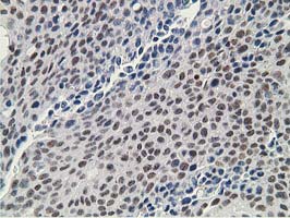 DCK / Deoxycytidine kinase Antibody - IHC of paraffin-embedded Carcinoma of Human bladder tissue using anti-DCK mouse monoclonal antibody.