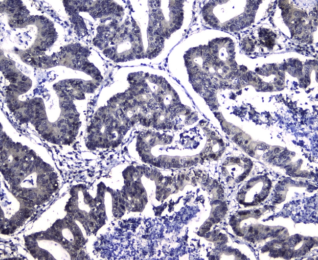 DCK / Deoxycytidine kinase Antibody - IHC analysis of DCK using anti-DCK antibody. DCK was detected in paraffin-embedded section of human intestinal cancer tissues. Heat mediated antigen retrieval was performed in citrate buffer (pH6, epitope retrieval solution) for 20 mins. The tissue section was blocked with 10% goat serum. The tissue section was then incubated with 1µg/ml rabbit anti-DCK Antibody overnight at 4°C. Biotinylated goat anti-rabbit IgG was used as secondary antibody and incubated for 30 minutes at 37°C. The tissue section was developed using Strepavidin-Biotin-Complex (SABC) with DAB as the chromogen.