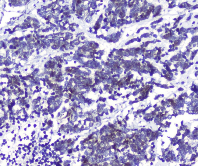 DCK / Deoxycytidine kinase Antibody - IHC analysis of DCK using anti-DCK antibody. DCK was detected in paraffin-embedded section of human lung cancer tissues. Heat mediated antigen retrieval was performed in citrate buffer (pH6, epitope retrieval solution) for 20 mins. The tissue section was blocked with 10% goat serum. The tissue section was then incubated with 1µg/ml rabbit anti-DCK Antibody overnight at 4°C. Biotinylated goat anti-rabbit IgG was used as secondary antibody and incubated for 30 minutes at 37°C. The tissue section was developed using Strepavidin-Biotin-Complex (SABC) with DAB as the chromogen.