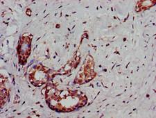 DCLK / DCLK1 Antibody - Immunohistochemistry image of paraffin-embedded human breast cancer at a dilution of 1:100