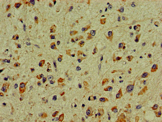 DCLK / DCLK1 Antibody - Immunohistochemistry image of paraffin-embedded human glioma cancer at a dilution of 1:100