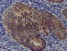 DCLRE1B Antibody - IHC of paraffin-embedded Adenocarcinoma of Human endometrium tissue using anti-DCLRE1B mouse monoclonal antibody. (Heat-induced epitope retrieval by 10mM citric buffer, pH6.0, 100C for 10min).