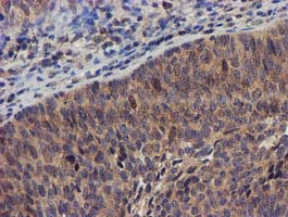 DCLRE1B Antibody - IHC of paraffin-embedded Carcinoma of Human bladder tissue using anti-DCLRE1B mouse monoclonal antibody. (Heat-induced epitope retrieval by 10mM citric buffer, pH6.0, 100C for 10min).