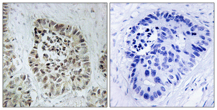 DCLRE1C / Artemis Antibody - Immunohistochemistry analysis of paraffin-embedded human lung carcinoma tissue, using Artemis Antibody. The picture on the right is blocked with the synthesized peptide.