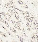 DCLRE1C / Artemis Antibody - Detection of Human Artemis by Immunohistochemistry. Sample: FFPE section of human breast carcinoma. Antibody: Affinity purified rabbit anti-Artemis used at a dilution of 1:250.