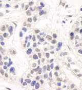 DCLRE1C / Artemis Antibody - Detection of Human Artemis by Immunohistochemistry. Sample: FFPE section of human breast carcinoma. Antibody: Affinity purified rabbit anti-Artemis used at a dilution of 1:1000 (1 ug/ml).