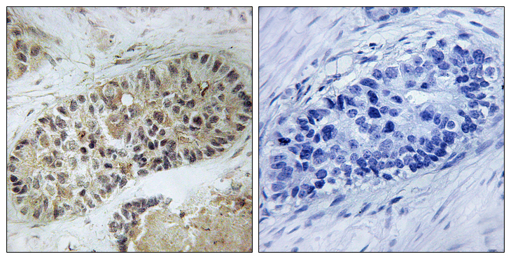 DCLRE1C / Artemis Antibody - Immunohistochemistry analysis of paraffin-embedded human lung carcinoma, using Artemis (Phospho-Ser516) Antibody. The picture on the right is blocked with the phospho peptide.