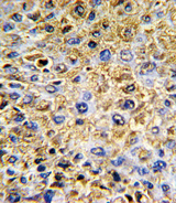 DCN / Decorin Antibody - Formalin-fixed and paraffin-embedded human hepatocarcinoma with DCN Antibody , which was peroxidase-conjugated to the secondary antibody, followed by DAB staining. This data demonstrates the use of this antibody for immunohistochemistry; clinical relevance has not been evaluated.