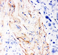 DCN / Decorin Antibody - Decorin antibody IHC-paraffin: Human Mammary Cancer Tissue.