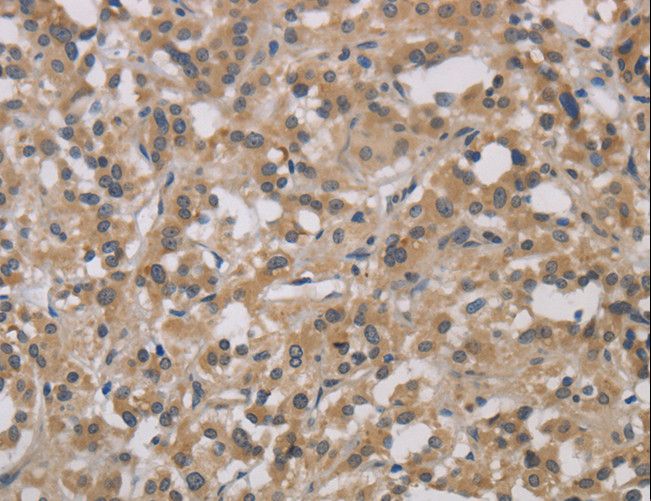 DCN / Decorin Antibody - Immunohistochemistry of paraffin-embedded Human gastric cancer using DCN Polyclonal Antibody at dilution of 1:30.