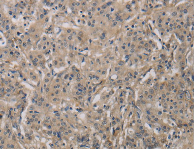 DCN / Decorin Antibody - Immunohistochemistry of paraffin-embedded Human gastric cancer using DCN Polyclonal Antibody at dilution of 1:30.