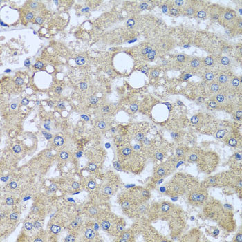 DCP2 Antibody - Immunohistochemistry of paraffin-embedded human liver injury tissue.