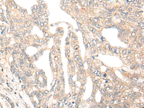 DCP2 Antibody - Immunohistochemistry of paraffin-embedded Human liver cancer tissue  using DCP2 Polyclonal Antibody at dilution of 1:45(×200)