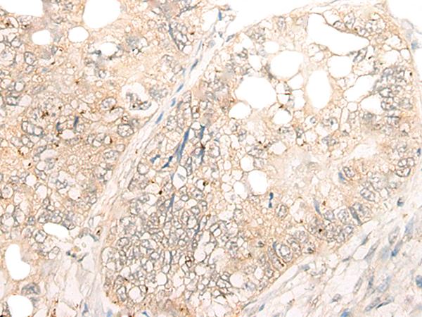 DCP2 Antibody - Immunohistochemistry of paraffin-embedded Human gastric cancer tissue  using DCP2 Polyclonal Antibody at dilution of 1:45(×200)