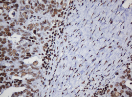 DCPS Antibody - IHC of paraffin-embedded Adenocarcinoma of Human ovary tissue using anti-DCPS mouse monoclonal antibody.