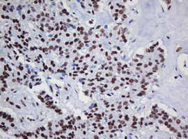 DCPS Antibody - IHC of paraffin-embedded Carcinoma of Human pancreas tissue using anti-DCPS mouse monoclonal antibody.