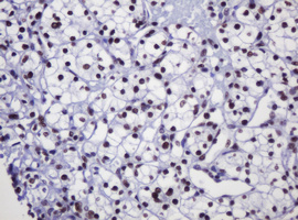 DCPS Antibody - IHC of paraffin-embedded Carcinoma of Human kidney tissue using anti-DCPS mouse monoclonal antibody.