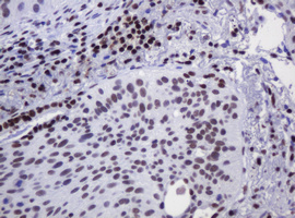 DCPS Antibody - IHC of paraffin-embedded Carcinoma of Human lung tissue using anti-DCPS mouse monoclonal antibody.