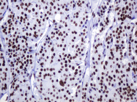 DCPS Antibody - IHC of paraffin-embedded Carcinoma of Human thyroid tissue using anti-DCPS mouse monoclonal antibody.