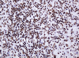 DCPS Antibody - IHC of paraffin-embedded Human lymphoma tissue using anti-DCPS mouse monoclonal antibody.