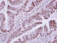 DCPS Antibody - IHC of paraffin-embedded Colon ca, using DCPS antibody at 1:250 dilution.