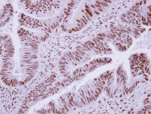 DCPS Antibody - IHC of paraffin-embedded Colon ca, using DCPS antibody at 1:250 dilution.