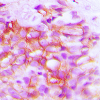 DCT / Dopachrome Tautomerase Antibody - Immunohistochemical analysis of TRP2 staining in human breast cancer formalin fixed paraffin embedded tissue section. The section was pre-treated using heat mediated antigen retrieval with sodium citrate buffer (pH 6.0). The section was then incubated with the antibody at room temperature and detected using an HRP conjugated compact polymer system. DAB was used as the chromogen. The section was then counterstained with hematoxylin and mounted with DPX.
